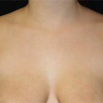 🥇 Reno NV Axillary Breast Tissue Removal