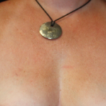 🥇 Reno NV Axillary Breast Tissue Removal