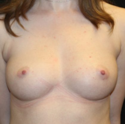 Breast Augmentation Before & After Patient #29385