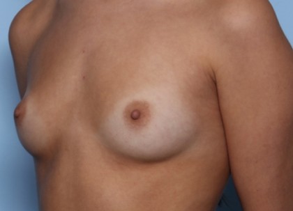 Breast Augmentation Before & After Patient #33406