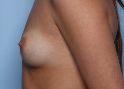 Breast Augmentation Before & After Patient #33406