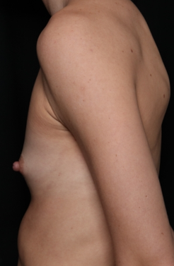Breast Augmentation Before & After Patient #33427