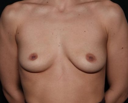 Breast Augmentation Before & After Patient #33491