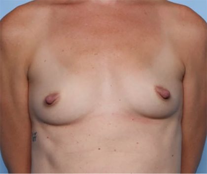 Breast Augmentation Before & After Patient #33585