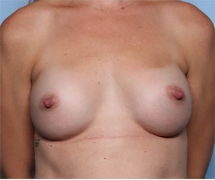 Breast Augmentation Before & After Patient #33585