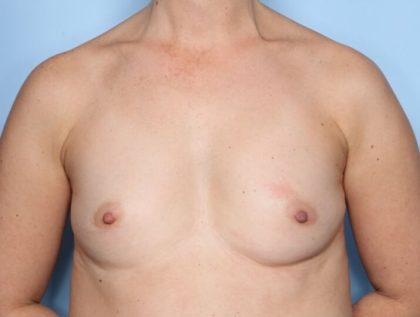 Breast Augmentation Before & After Patient #33606