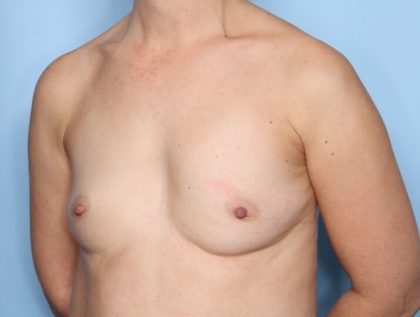 Breast Augmentation Before & After Patient #33606