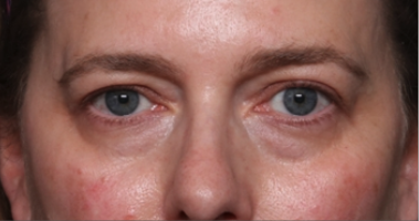 Blepharoplasty and Brow Lift Before & After Patient #34569