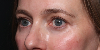 Blepharoplasty and Brow Lift Before & After Patient #34569