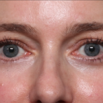 Brow Lift Before & After Patient #33660