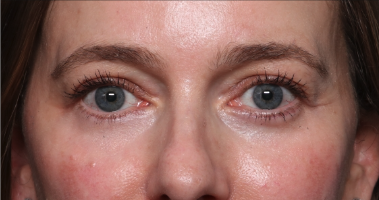 Brow Lift Before & After Patient #33660