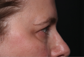 Blepharoplasty and Brow Lift Before & After Patient #34569