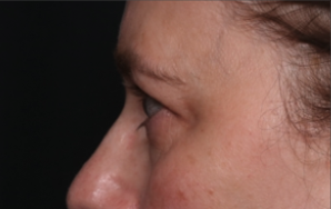 Blepharoplasty and Brow Lift Before & After Patient #34569