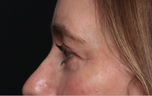 Brow Lift Before & After Patient #33660