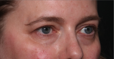 Blepharoplasty and Brow Lift Before & After Patient #34569