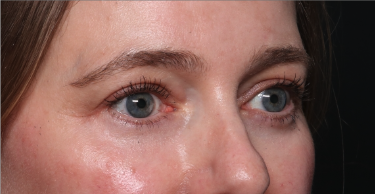 Brow Lift Before & After Patient #33660