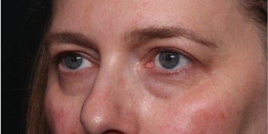 Brow Lift Before & After Patient #33660