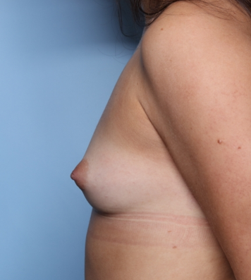 Breast Augmentation Before & After Patient #33761