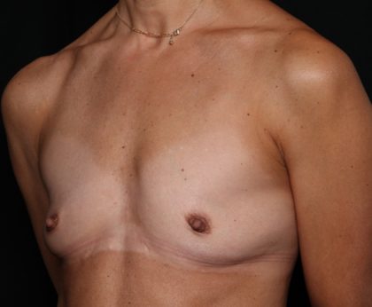 Breast Augmentation Before & After Patient #33959
