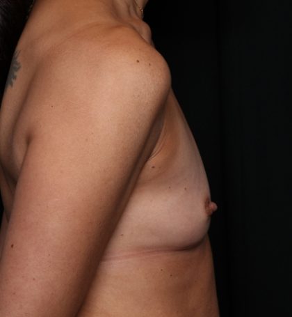 Breast Augmentation Before & After Patient #33959