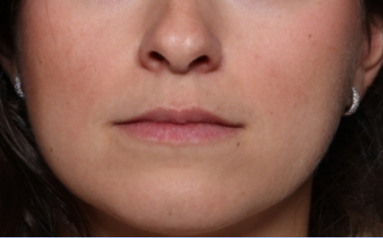 Lip Filler Before & After Patient #34178