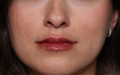 Lip Filler Before & After Patient #34178