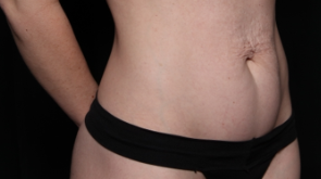 Tummy Tuck Before & After Patient #34156