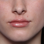 Lip Filler Before & After Patient #34169