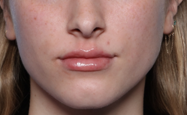 Lip Filler Before & After Patient #34169