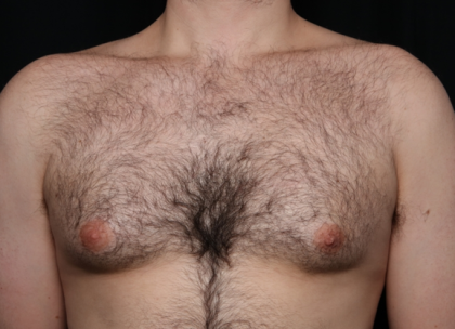 Gynecomastia Before & After Patient #34192