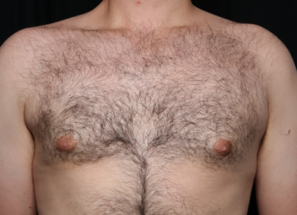 Gynecomastia Before & After Patient #34192