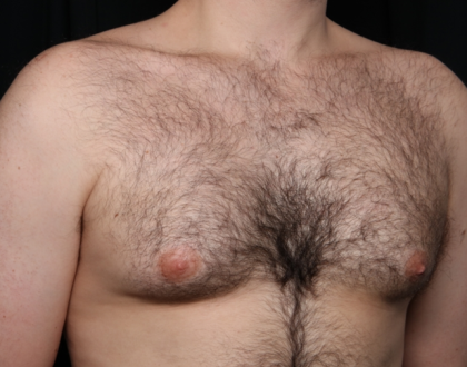 Gynecomastia Before & After Patient #34192