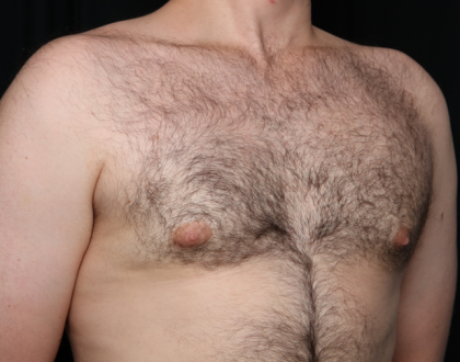 Gynecomastia Before & After Patient #34192