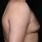 Gynecomastia Before & After Patient #34192