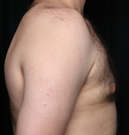 Gynecomastia Before & After Patient #34192