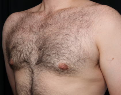 Gynecomastia Before & After Patient #34192