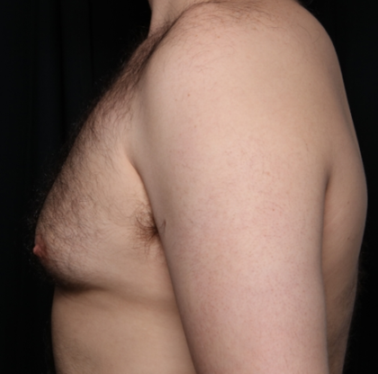 Gynecomastia Before & After Patient #34192