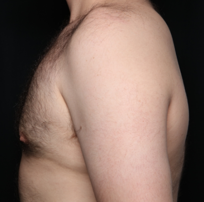 Gynecomastia Before & After Patient #34192