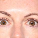 Blepharoplasty Before & After Patient #34185