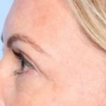 Blepharoplasty Before & After Patient #34185