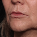 Injectable Fillers Before & After Patient #34288