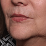 Injectable Fillers Before & After Patient #34288