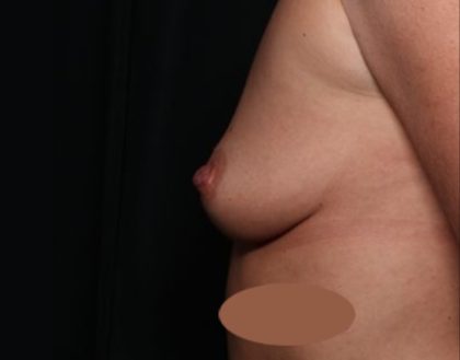 Breast Augmentation Before & After Patient #34487