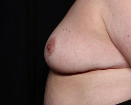 Breast Reduction Before & After Patient #34476