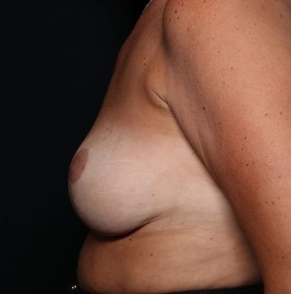 Breast Reduction Before & After Patient #34535