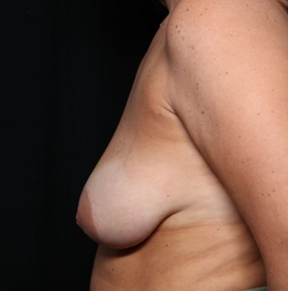 Breast Reduction Before & After Patient #34535