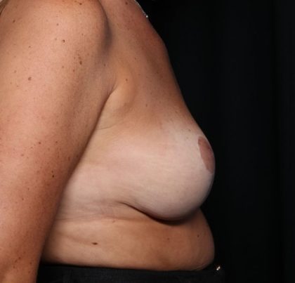 Breast Reduction Before & After Patient #34535