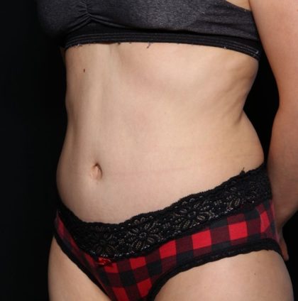 Tummy Tuck Before & After Patient #34421