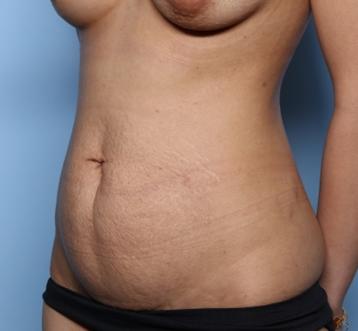 Tummy Tuck Before & After Patient #34386