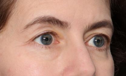 Blepharoplasty Before & After Patient #34395